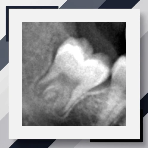 Third Molar Maturity Index (I3M)